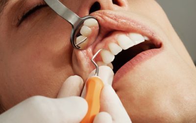 Paradentose behandling forebygger rådne tænder